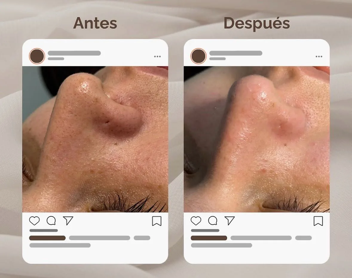 Limpieza Facial Profunda en Franceska Beltrán Studio Medellín